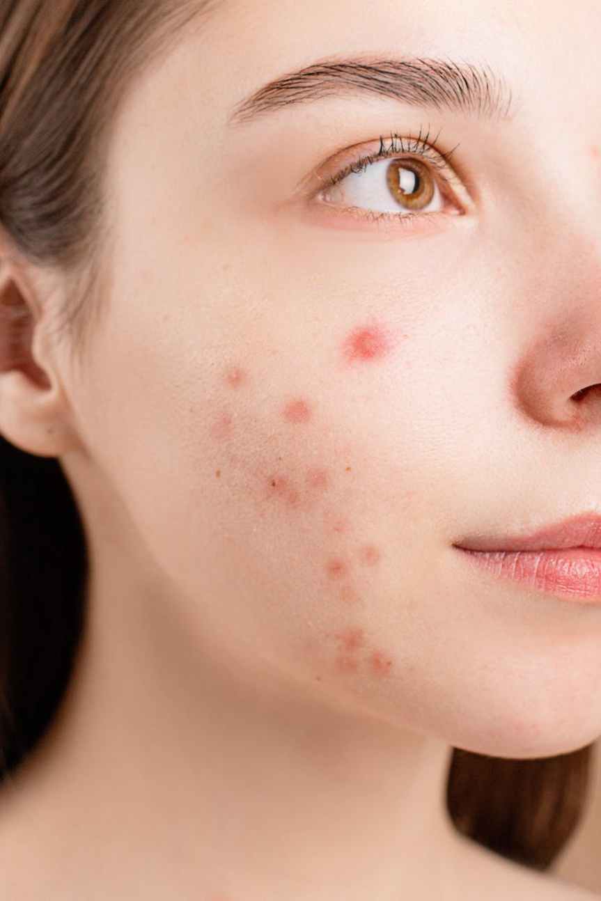 The Impact of PCOD on Skin&nbsp;Health