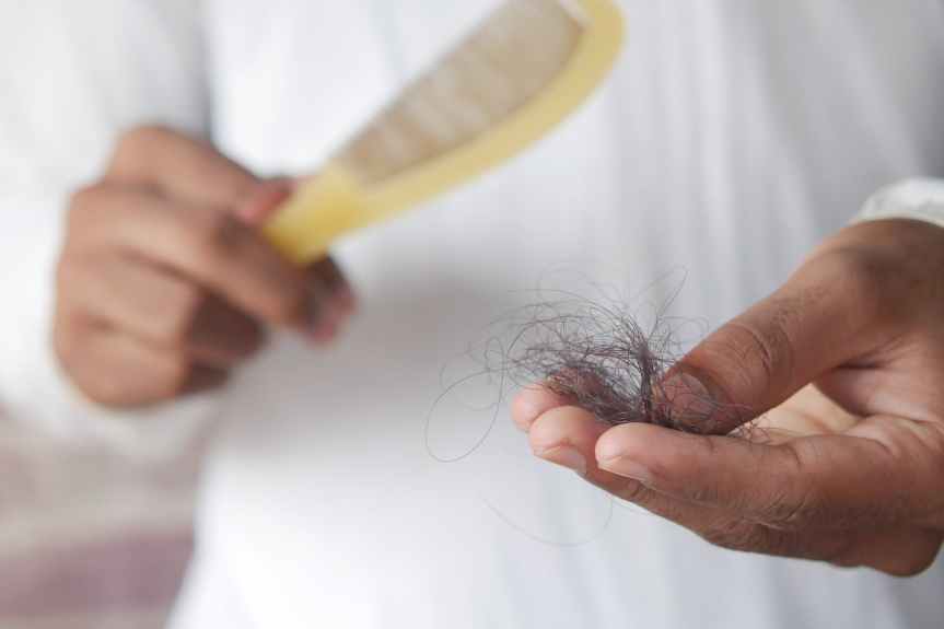 Understanding Androgenic Alopecia: The Common Cause of Hair&nbsp;Loss